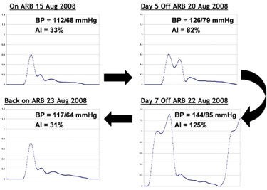 BP+ Effect of an ARB on Augmentation Index